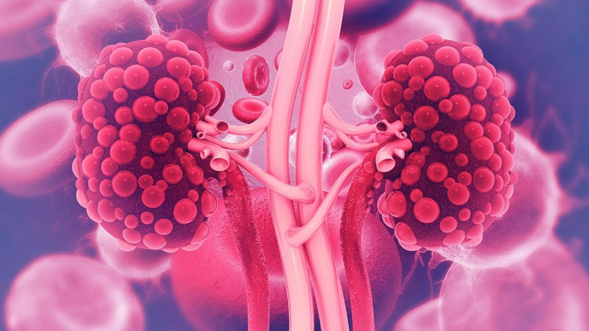 بیماری کلیه پلی کیستیک اتوزومال مغلوب