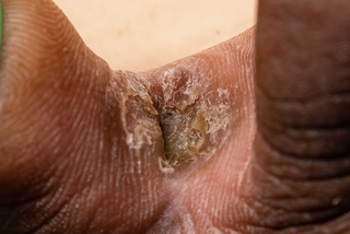 پای ورزشکار روی پوست قهوه ای تیره.  نمای نزدیک از 2 انگشت پا.  بین انگشتان پا یک لکه پوسته پوسته، قهوه ای تیره و کمی سفید وجود دارد.