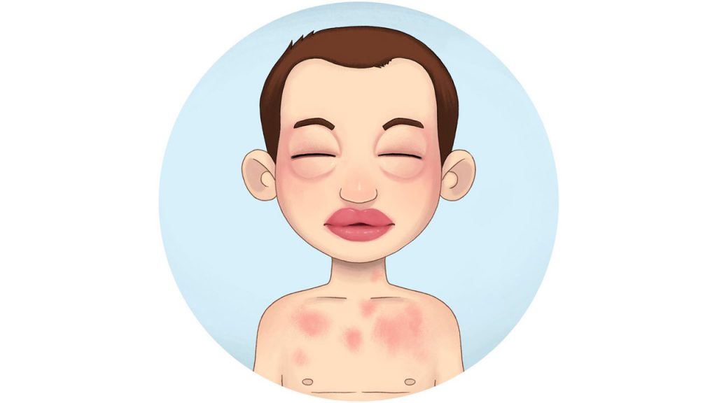 آنافیلاکسی