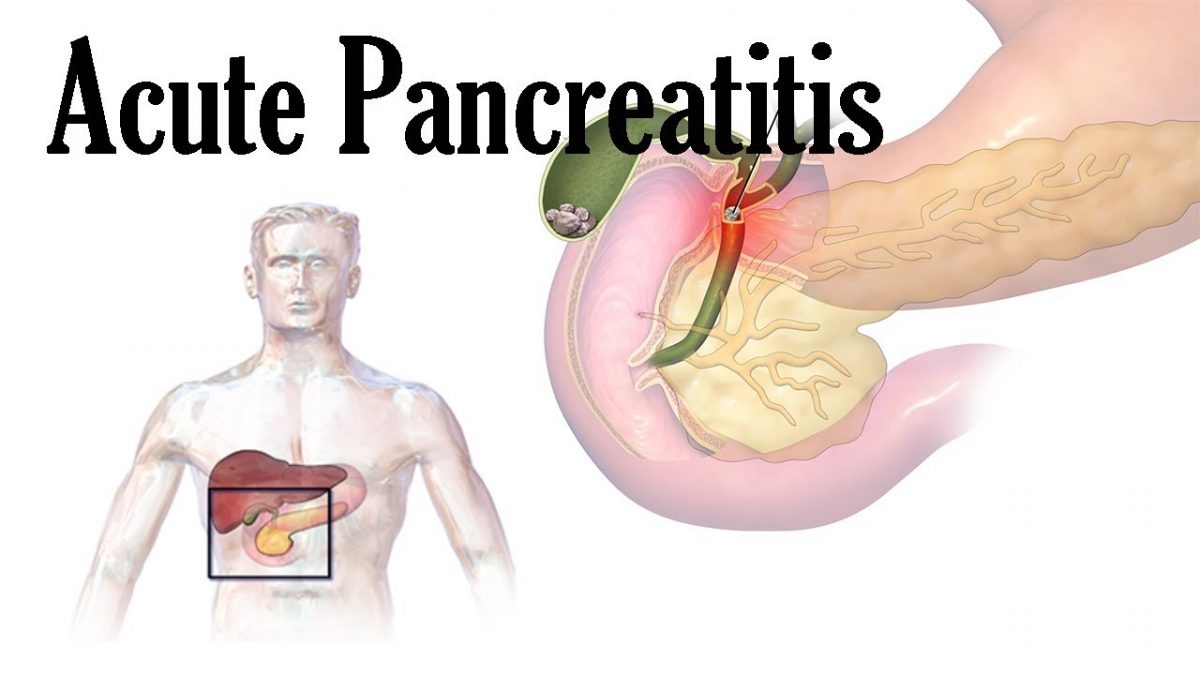 درمان پانکراتیت حاد