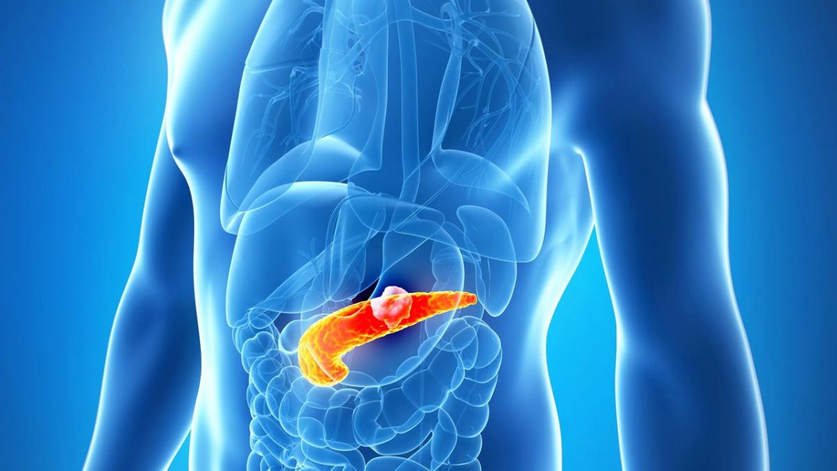 علائم پانکراتیت حاد