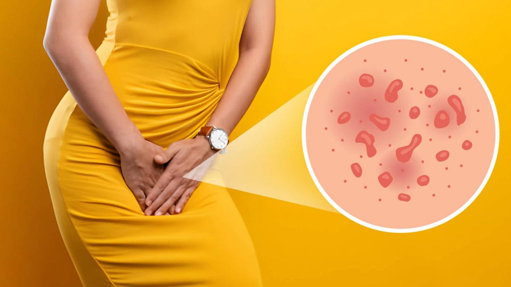 تبخال تناسلی